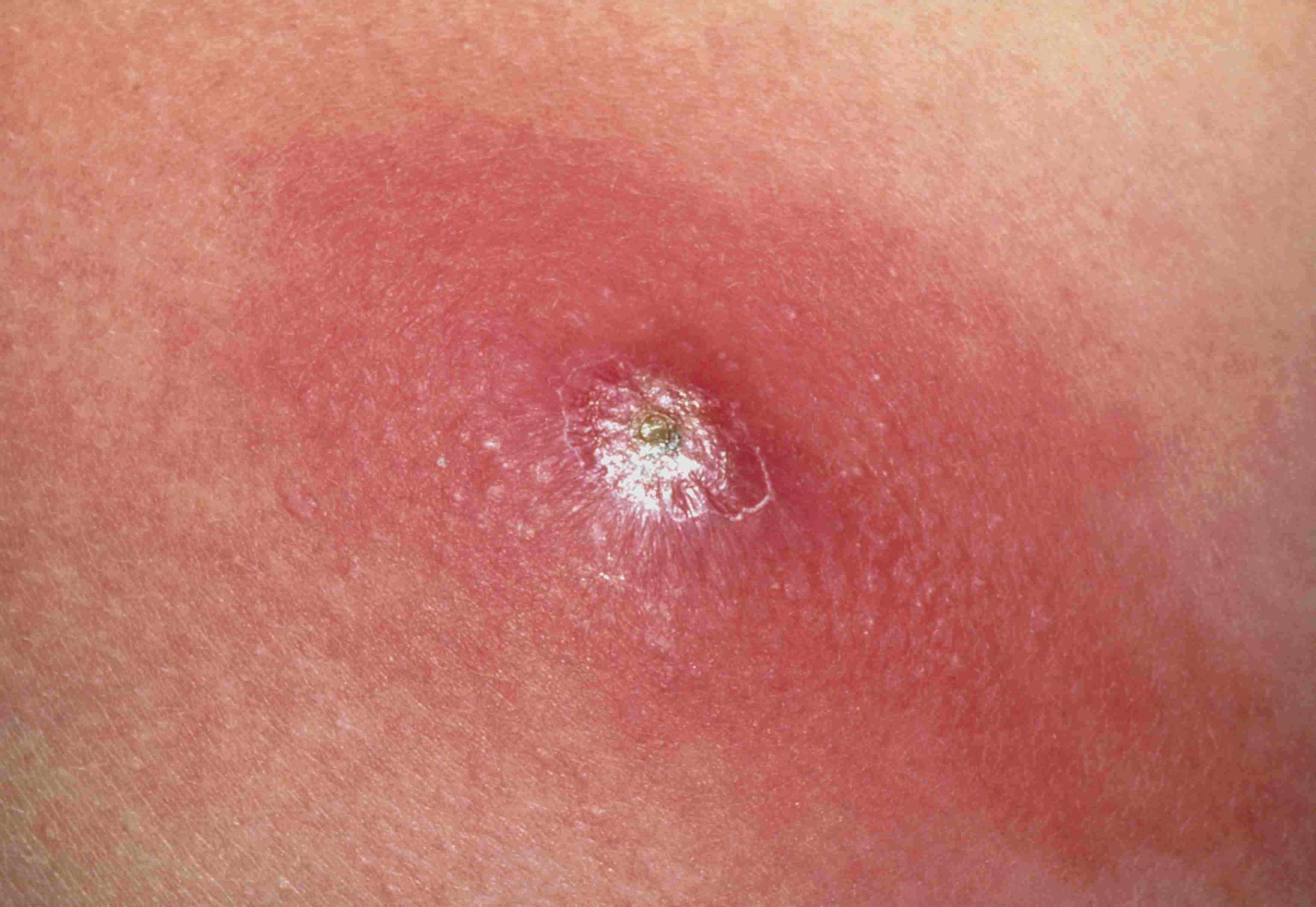 MRSA infection