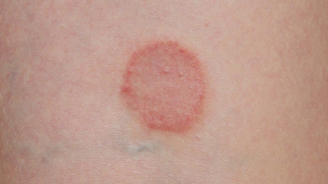 Ringworm is a common infection you can catch at the gym.